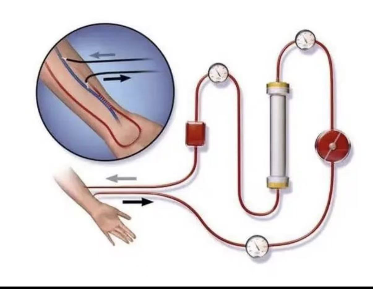 我的内瘘又堵了!内瘘为什么会发生堵塞？如何预防？